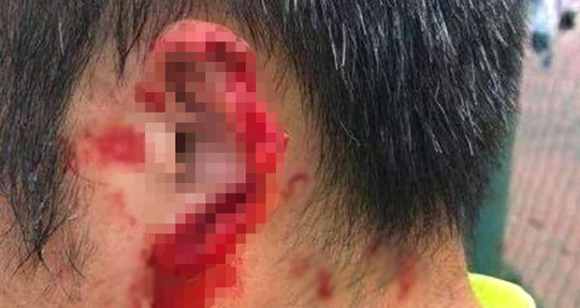 Çin’de Futbolcu Kavga Ettiği Rakibinin Kulağını Isırarak Kopardı